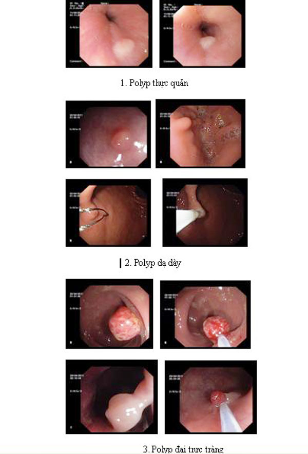 Cắt polyp thực quản, dạ dày tá tràng, đại trực tràng qua nội soi tại Bệnh viện Nông nghiệp