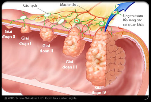 Cần phát hiện và điều trị sớm ung thư đại tràng