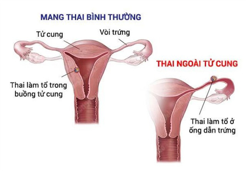 Cứu sống bệnh nhân sốc mất máu do chửa ngoài tử cung