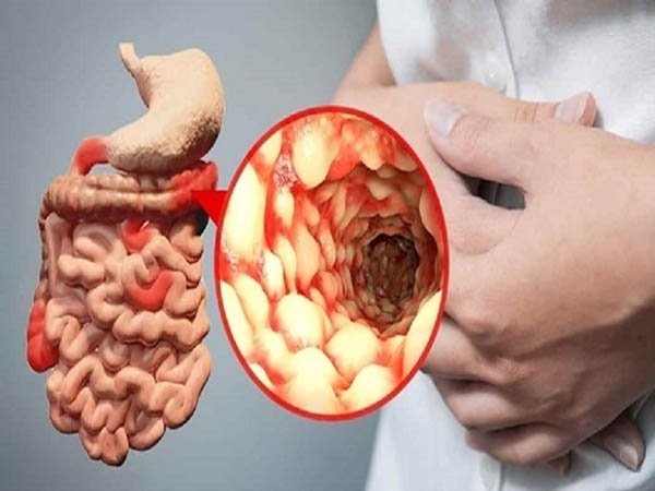 Bệnh Crohn: Nguyên nhân, triệu chứng, chẩn đoán và điều trị