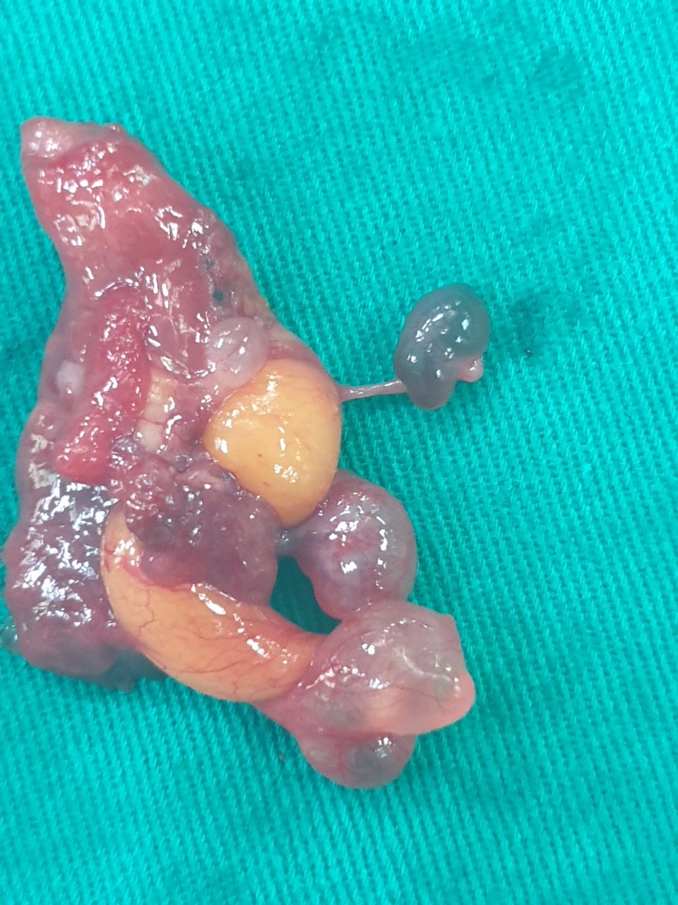 PHẪU THUẬT LẤY THAI KÈM BÓC U XƠ BẢO TỒN TỬ CUNG CHO SẢN PHỤ TỪNG 2 LẦN MỔ ĐẺ CŨ