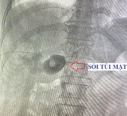 TÁN SỎI TÚI MẬT QUA DA BẰNG LASER, HƯỚNG TIẾP CẬN BẢO TỒN TÚI MẬT